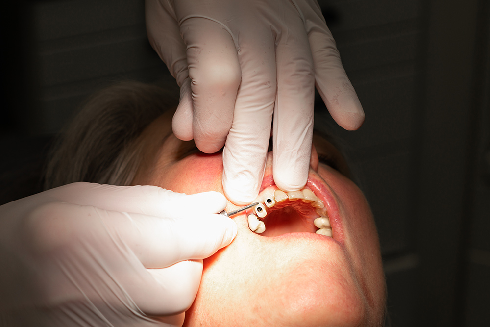 Zahnersatz: Festsitzende Zahnkronen und Zahnbrücken, herausnehmbare Teil- und Totalprothesen
